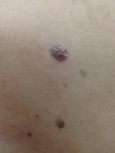 背上突然长了颗痣,不知道是不是痣,但也不知道是什么,不痛的,有人知道