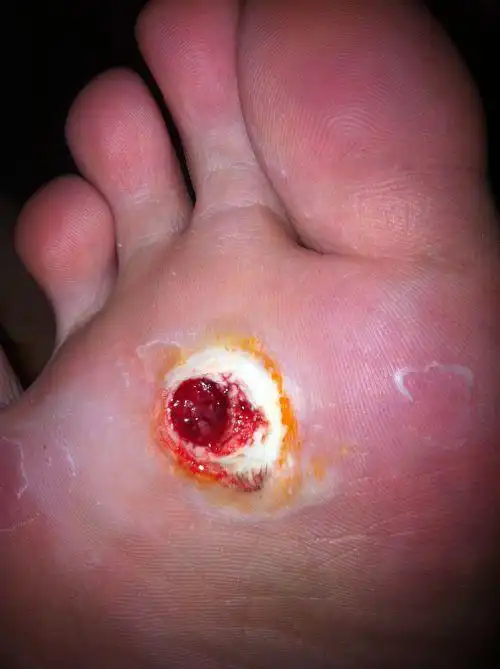 鸡眼拔出根以后有个坑.