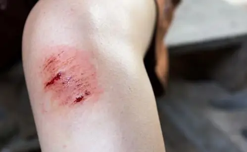 生活中难免磕磕碰碰,意外受伤后究竟要不要打破伤风针?_伤口