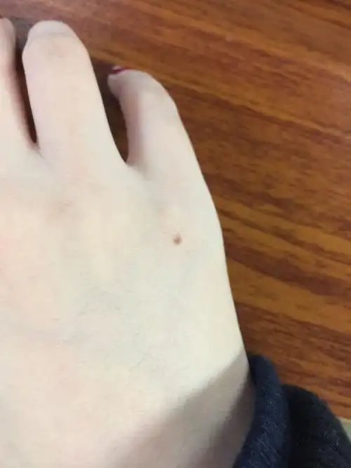 右手小指上有一颗痣 代表什么?