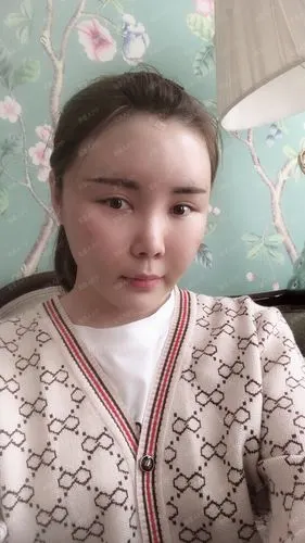 【脂肪填充饱满童颜术后7天】