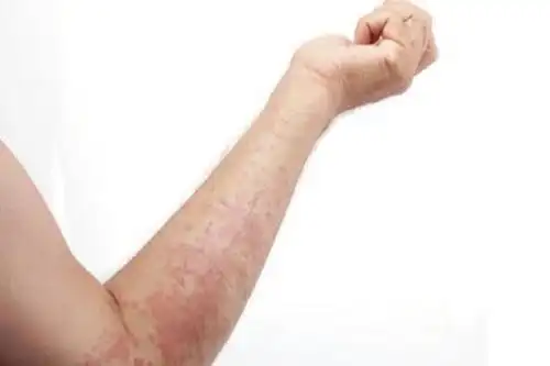 夏天皮炎湿疹怎么预防呢有哪些不错的方法