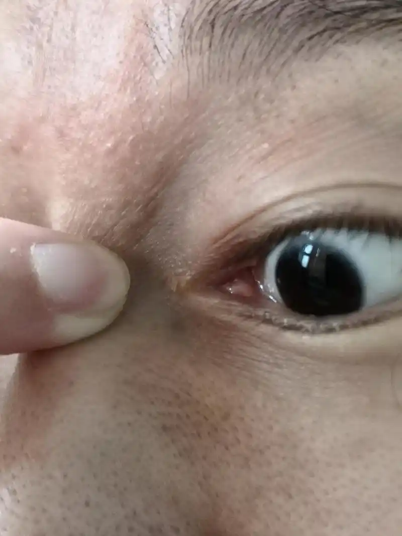 眼睑内眼角褶皱部位的颗粒物.#解决皮肤问题专注皮肤美容##皮赘