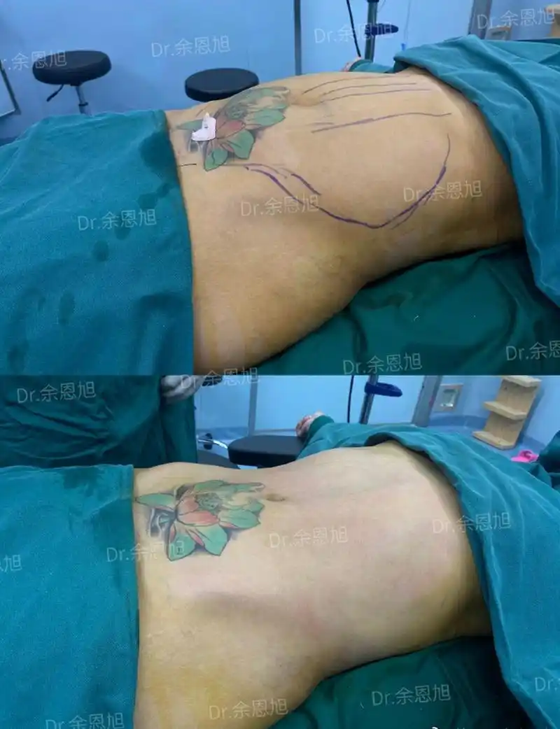 很多妈妈生完孩子之后,身材走样出现了皮肤松弛,妊娠纹,还有腰腹