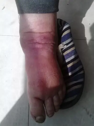 问题:肾病综合症全身浮肿,尿蛋白