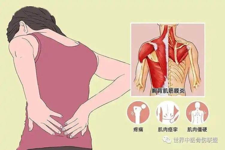 筋膜炎的具体病因尚不明确,可能是与慢性劳损或受寒等因素导致胸背部