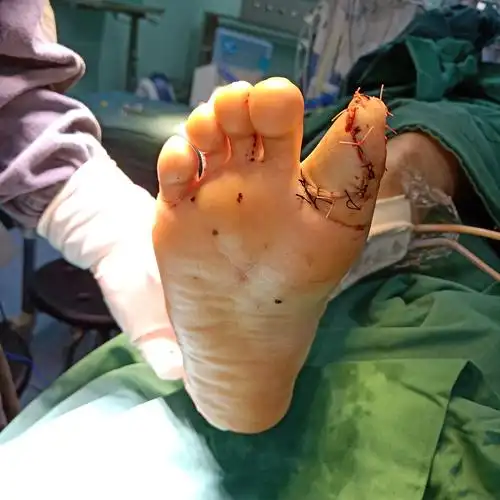 为设计人员完美再造拇指一例 - 好大夫在线