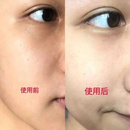 为什么你的脸老补水都会干燥出油?大小气泡了解一下