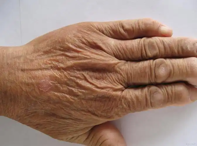 老年人皮肤病 - 皮肤及性传播疾病讨论版 - 爱爱医医学论坛