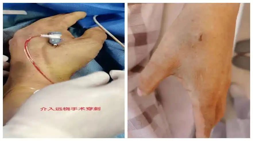 拆除加压绷带后,穿刺伤口愈合良好,皮肤血供良好介入科致力于以患者最