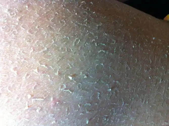 病例会诊一例红斑鳞屑性皮肤病鳞状毛囊角化症