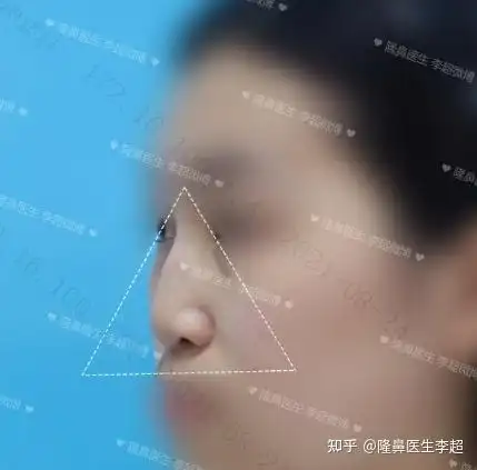 浅谈binder综合症一种你可能没听说但绝对熟悉的颅颌面疾病