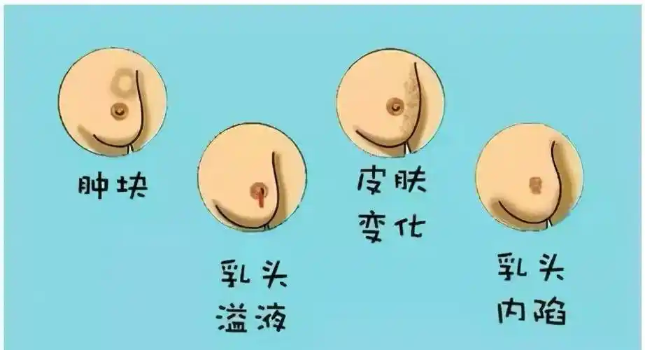 乳腺病风险很大甚至威胁生命,为防止乳腺病发生,日常注意4症状_乳头