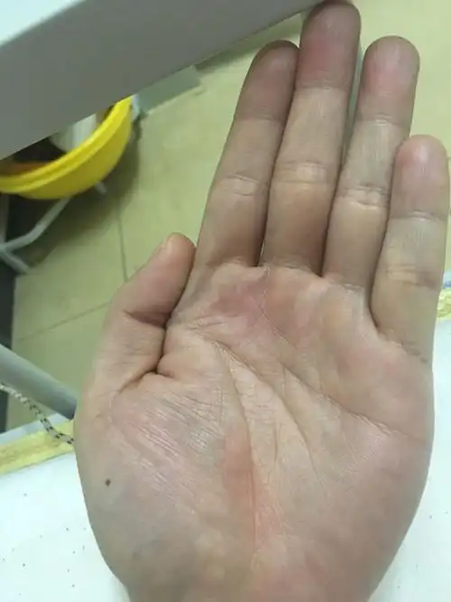 男性,左手,特别是那颗痣,好不好?