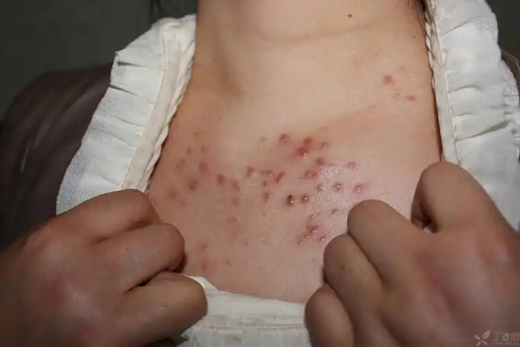 【病例讨论】胸前皮肤长片状红疹