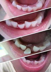 这样吃饭,孩子容易长出两层牙!