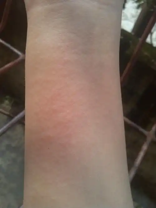 3 2011-09-04 右胳膊的皮肤里面长了个疙瘩是怎么回事啊?