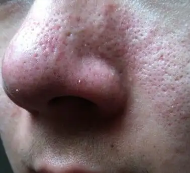 毛孔堵塞才是皮肤痘痘的原因