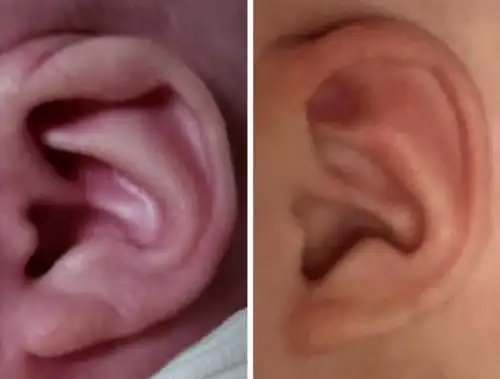 全国爱耳日 | 原来耳朵也有畸形,出生后这个时间段,矫正才有用_耳廓