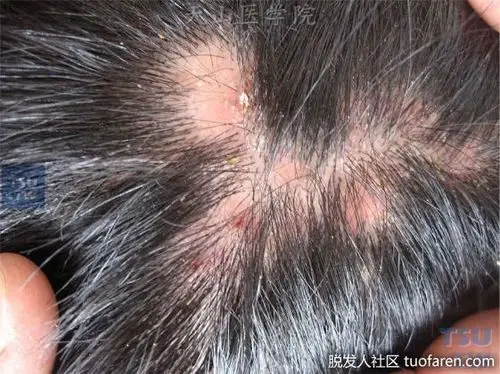 什么是毛囊炎性脱发