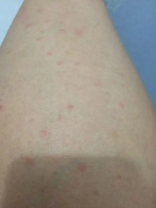 然后身上长满了这样的痘痘,好可怕,朋友说是可能水土不服,过两天