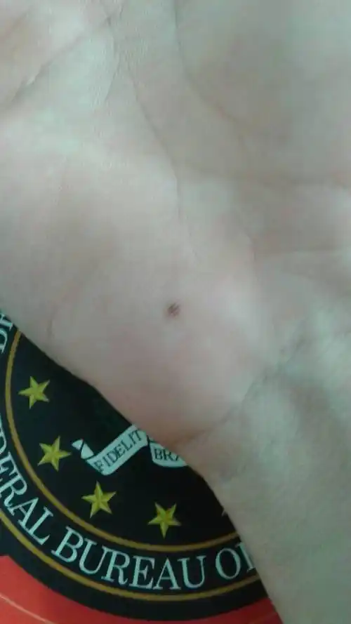 手上这颗痣需要去掉吗?