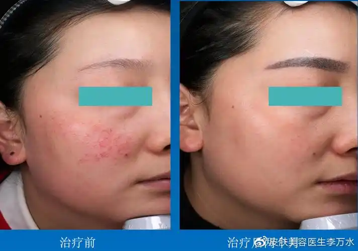 m22去红血丝真人案例