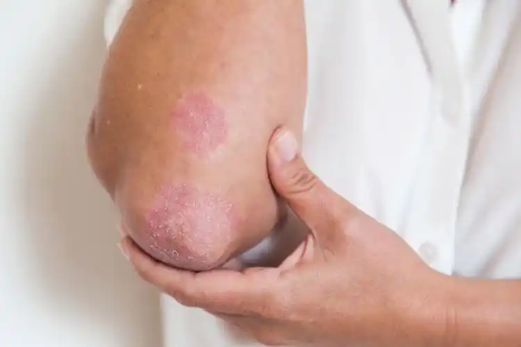 湿疹瘙痒总是好不利索没成想用皮清夫草本乳膏治愈了