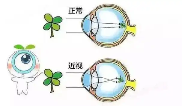 我为什么这么说那,首先要先知道近视眼的含义.