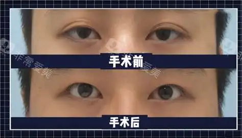 韩国来丽整形用案例说明双眼皮改单眼皮手术的优缺点!