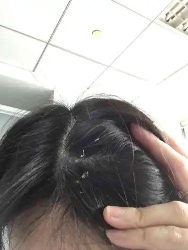 团购了,做完几天洗头,头皮屑大块大块的,从来没有这么恶心过,损伤头皮
