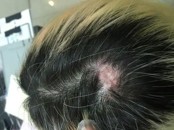 浅层的可能会死,深层的只会越来越往深处钻,而且60度的高温会伤害头皮