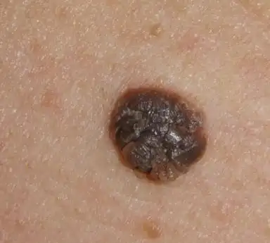 容易癌变的痣的图片