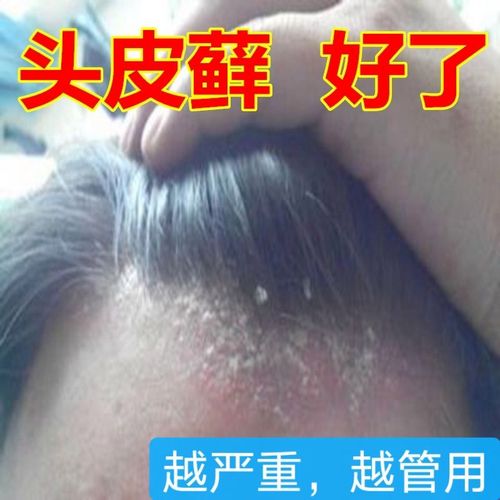 治头部头癣头皮藓真菌引起毛囊发炎红疙瘩脂溢头皮痒药膏非洗发水