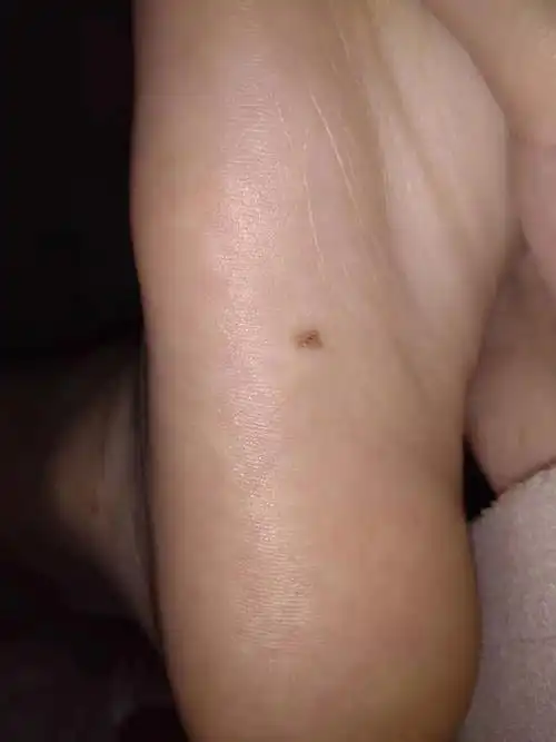 脚底下新长出一颗痣