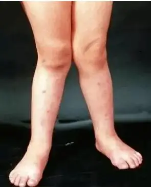 雨季高发儿童佝偻病,决非危言耸听!