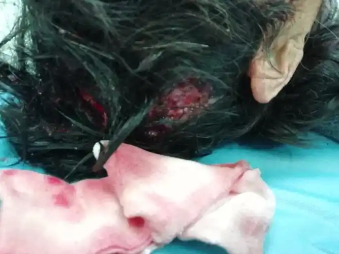 9床车祸伤导致头皮撕裂伤伴局部缺损