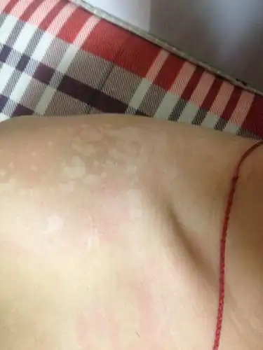 问:汗斑怎么治 需要注意什么