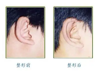 专家:哪种耳朵需要整形?