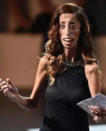 曾破吉尼斯最瘦纪录的骷髅女孩,只有27公斤,如今成励志女孩