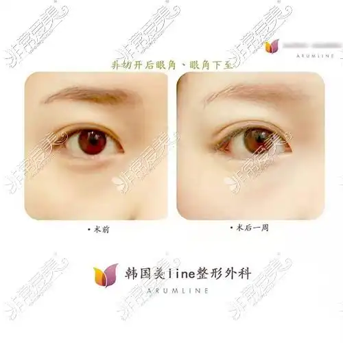 眼尾下至手术前后对比图