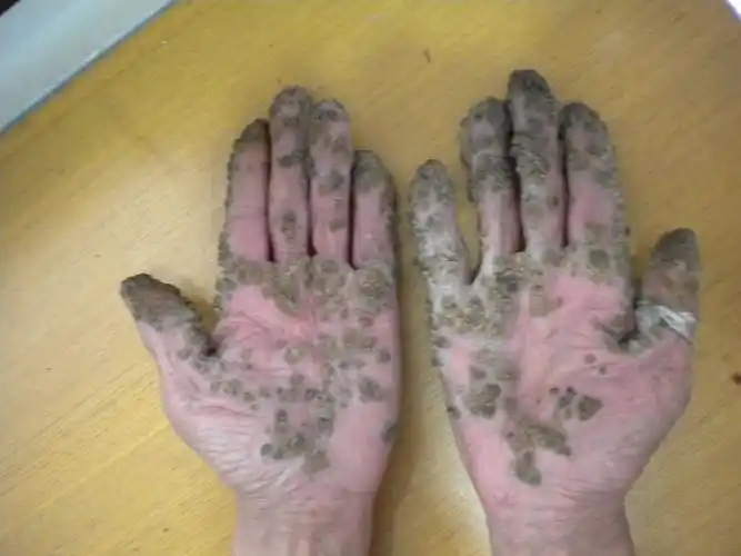 怀疑双手双足多发鸡眼?就各位诊治?