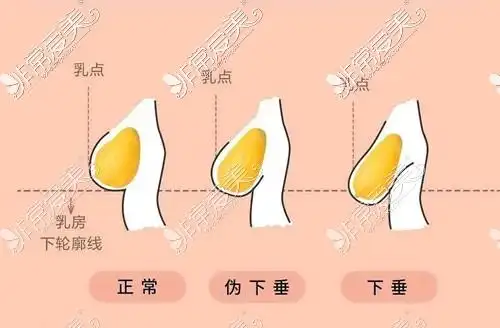 正常胸型与下垂胸区别图