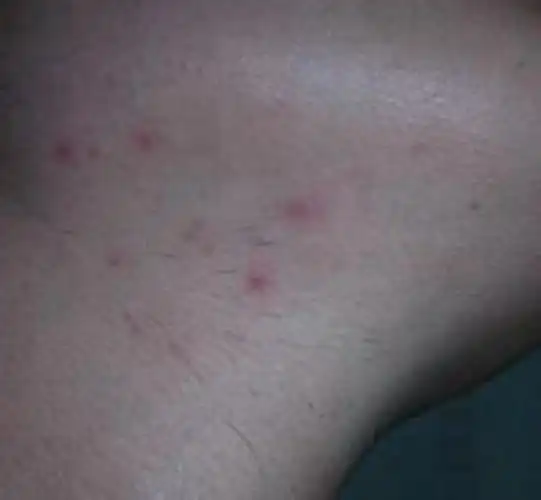 阴茎长毛囊炎的症状图片