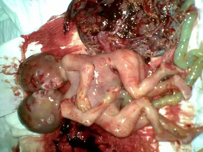 20:51:11最近一位b超发现连体婴儿的孕妇来引产,孩子出来就是这样的!