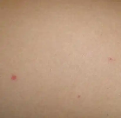 艾滋病大腿上红点图片 (6)