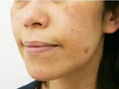 脸上肝斑图片54