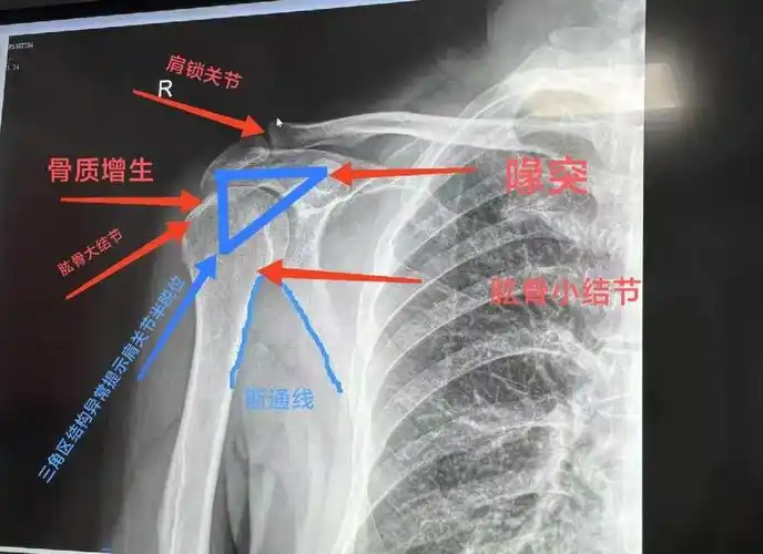 肩关节x线和mri学习要点