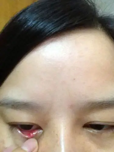 2013-09-12 张哲 主治医生 眼睛上眼皮内侧长了一个白色脓包,又有点