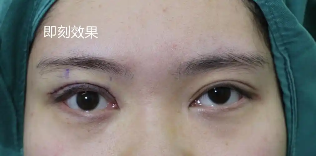 河北90后姑娘右眼上睑下垂做了一次效果不好,来找我们做了修复